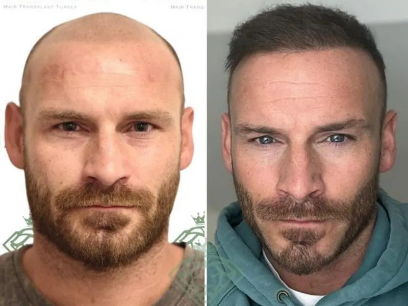 hair transplant turkey cost