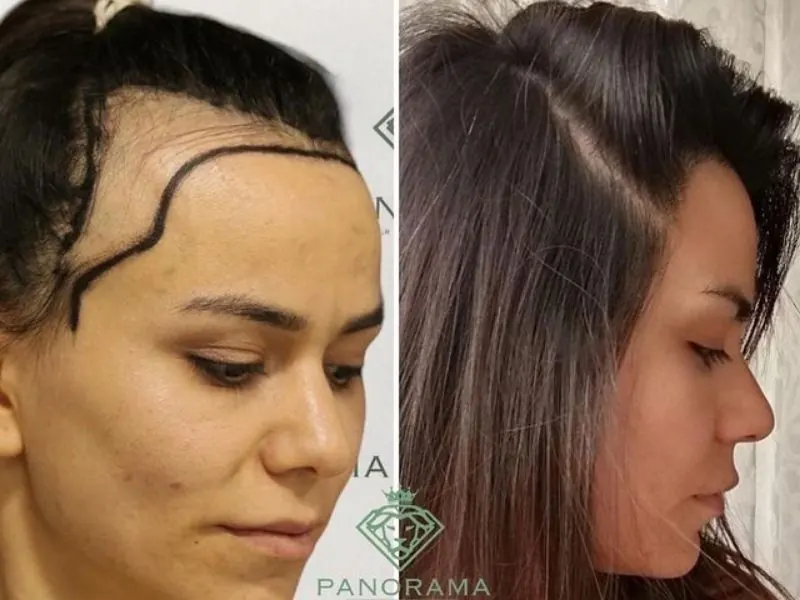 hair transplant