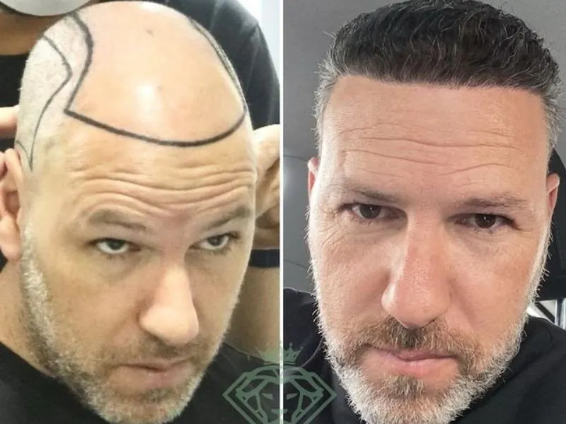 hair transplantation