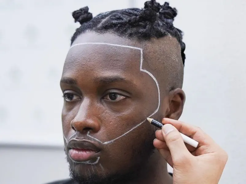hair transplant