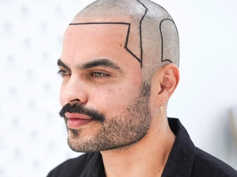 hair transplant