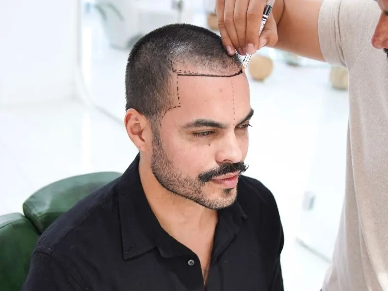 hair transplant
