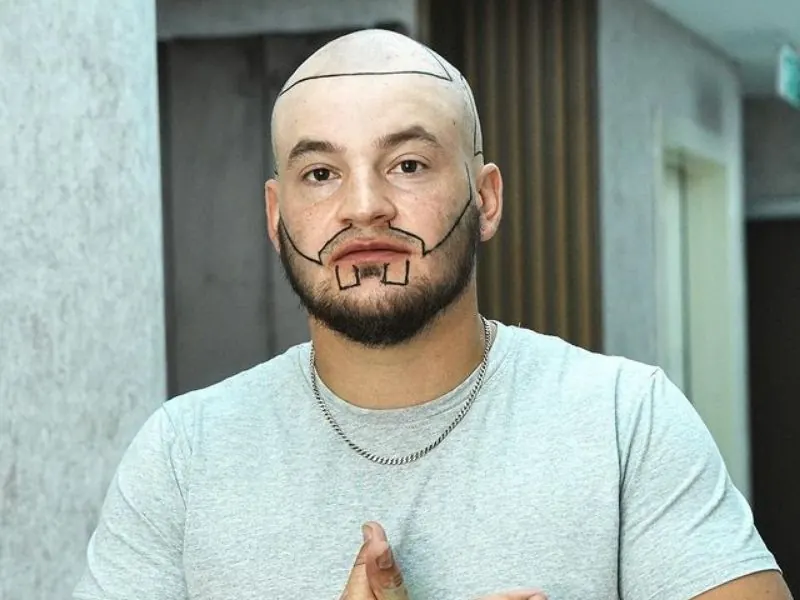 hair transplant turkey cost