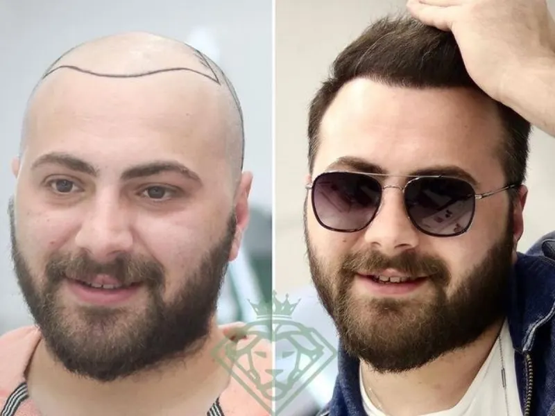 hair transplant
