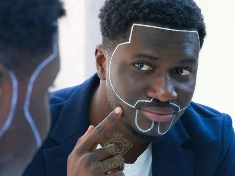 hair transplant