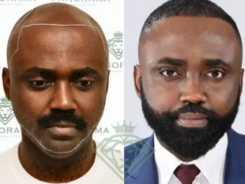 Itching After Hair Transplant