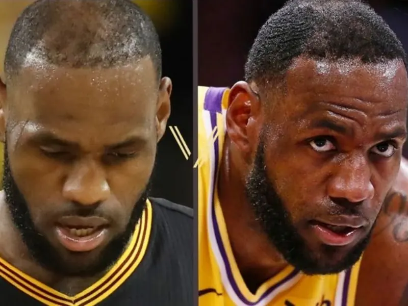 hair transplantation