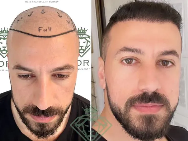 زراعة الشعر قبل وبعد — الحالة 01، تساقط الشعر المتقدم