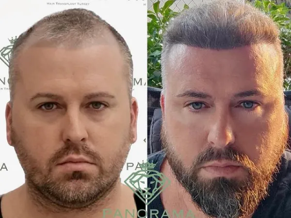 زراعة الشعر قبل وبعد — الحالة 02، تساقط الشعر المتقدم