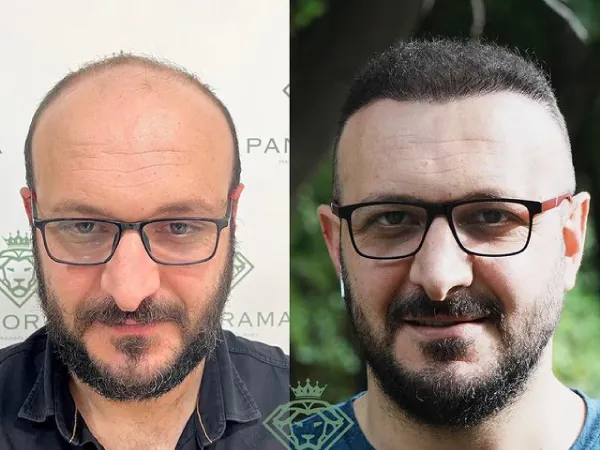 Injerto capilar antes y después: caso 03, entradas