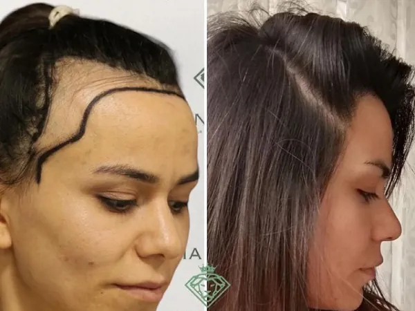 زراعة الشعر قبل وبعد — الحالة 05، تساقط الشعر لدى النساء