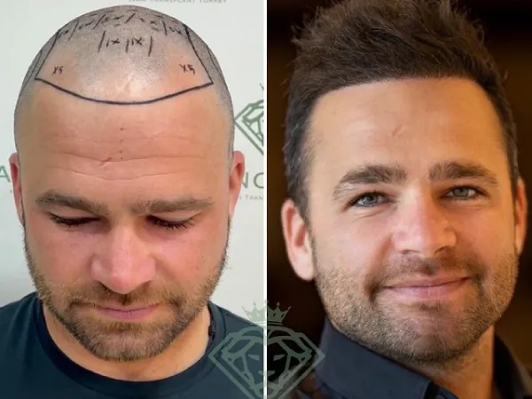 زراعة الشعر قبل وبعد — الحالة 06، تساقط الشعر المتقدم