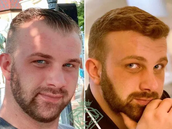 Injerto capilar antes y después: caso 07, entradas
