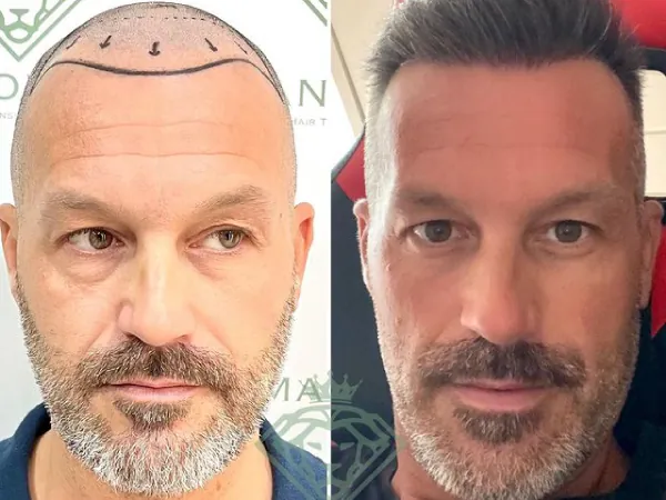 زراعة الشعر قبل وبعد — الحالة 08، تساقط الشعر المتقدم