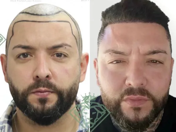 زراعة الشعر قبل وبعد — الحالة 09، انحسار خط الشعر