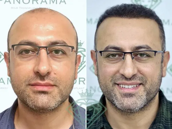زراعة الشعر قبل وبعد — الحالة 10، انحسار خط الشعر