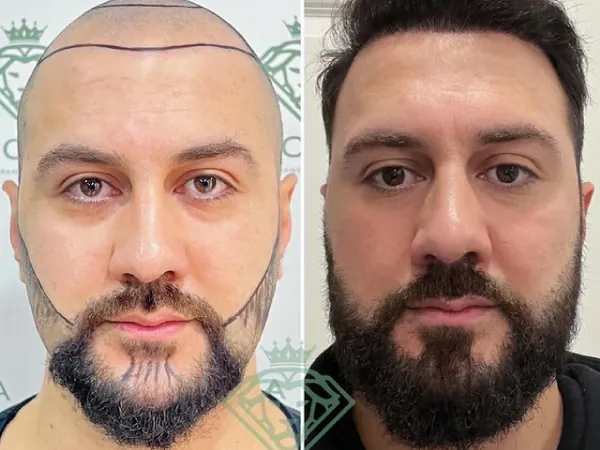زراعة الشعر قبل وبعد — الحالة 11، الشعر واللحية