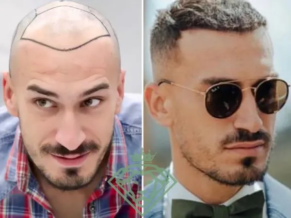 زراعة الشعر قبل وبعد — الحالة 14، انحسار خط الشعر