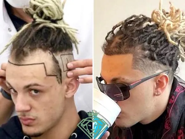 زراعة الشعر قبل وبعد — الحالة 16، انحسار خط الشعر