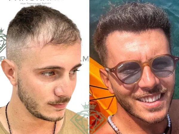 زراعة الشعر قبل وبعد — الحالة 17، انحسار خط الشعر