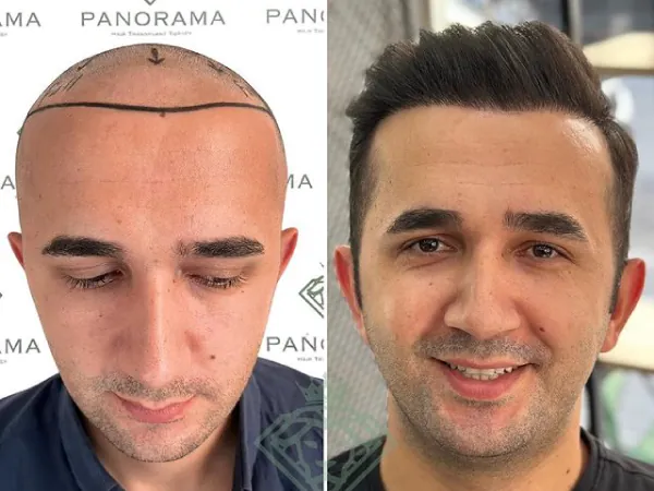 زراعة الشعر قبل وبعد — الحالة 18، انحسار خط الشعر