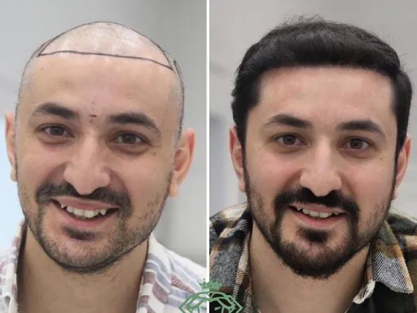 زراعة الشعر قبل وبعد — الحالة 19، انحسار خط الشعر
