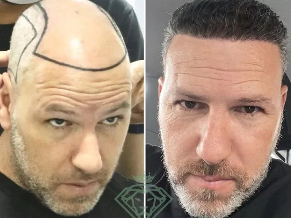 زراعة الشعر قبل وبعد — الحالة 20، تساقط الشعر المتقدم