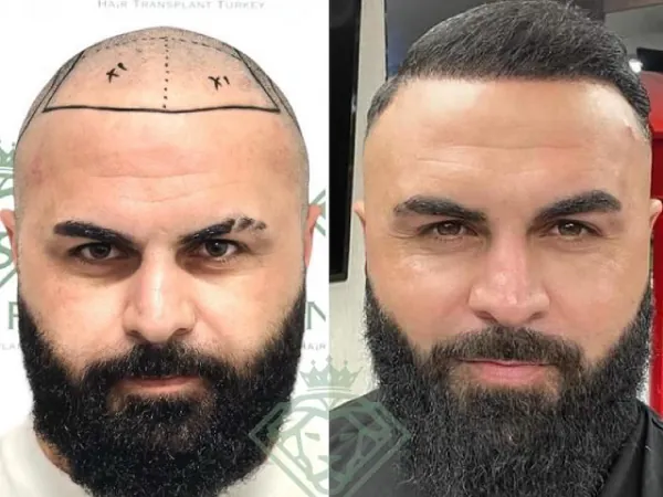 زراعة الشعر قبل وبعد — الحالة 21، تساقط الشعر المتقدم