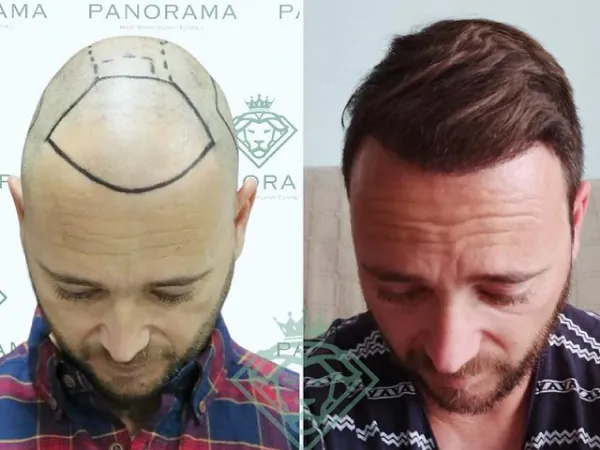 زراعة الشعر قبل وبعد — الحالة 22، تساقط الشعر المتقدم