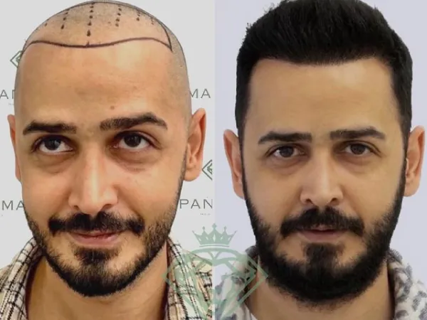 زراعة الشعر قبل وبعد — الحالة 23، انحسار خط الشعر