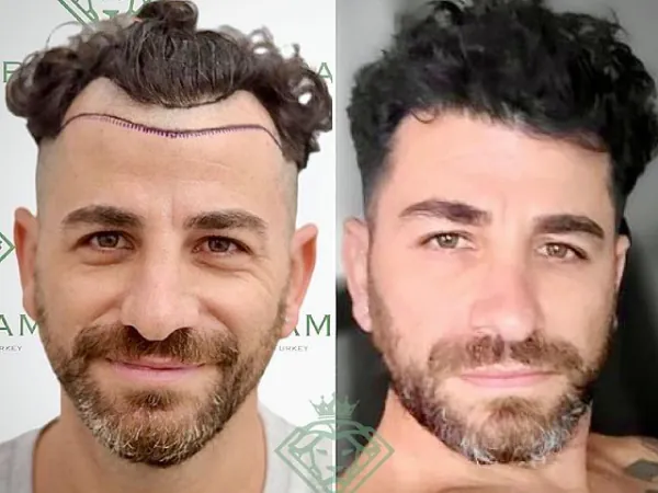 زراعة الشعر قبل وبعد — الحالة 24، انحسار خط الشعر
