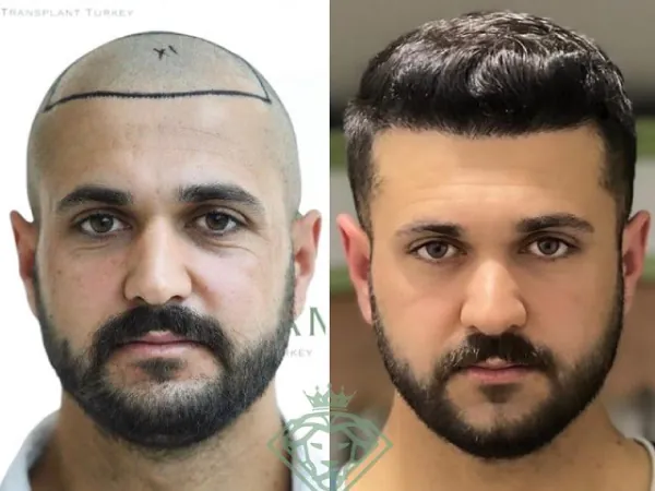 زراعة الشعر قبل وبعد — الحالة 25، انحسار خط الشعر