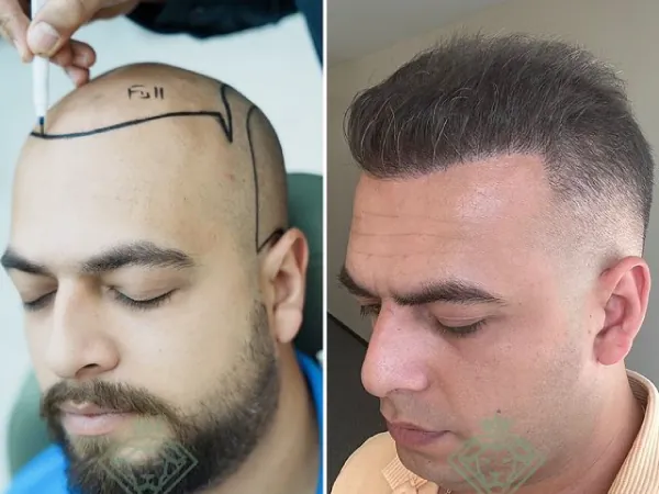 زراعة الشعر قبل وبعد — الحالة 26، انحسار خط الشعر
