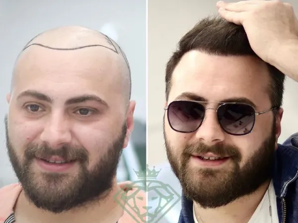 زراعة الشعر قبل وبعد — الحالة 27، انحسار خط الشعر