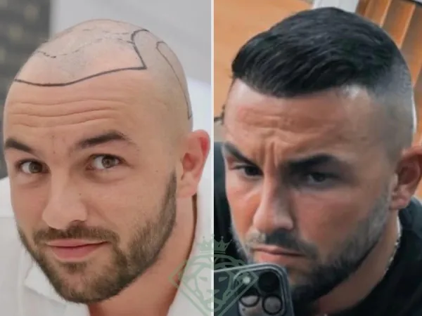 زراعة الشعر قبل وبعد — الحالة 28، تساقط الشعر المتقدم