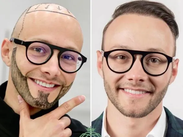 زراعة الشعر قبل وبعد — الحالة 29، الشعر واللحية