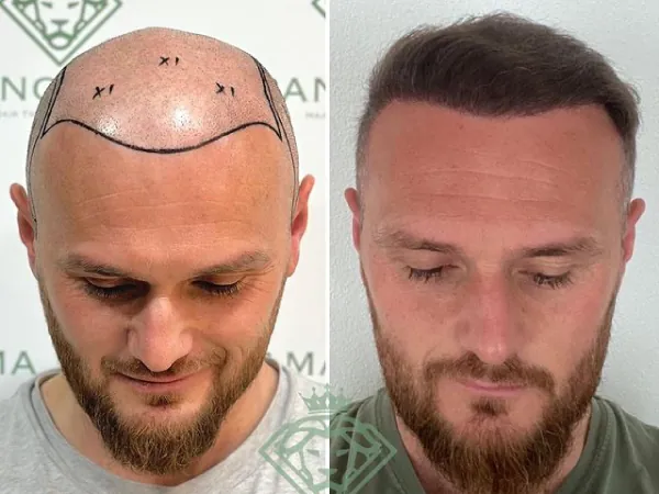 زراعة الشعر قبل وبعد — الحالة 30، تساقط الشعر المتقدم