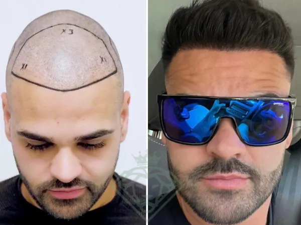 زراعة الشعر قبل وبعد — الحالة 31، تساقط الشعر المتقدم