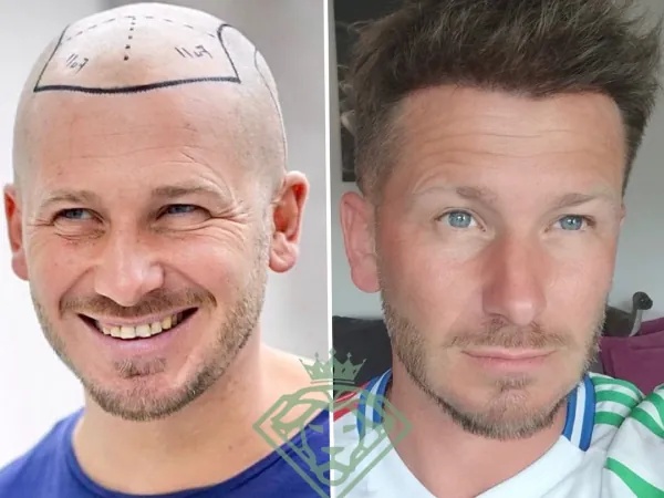 زراعة الشعر قبل وبعد — الحالة 32، تساقط الشعر المتقدم