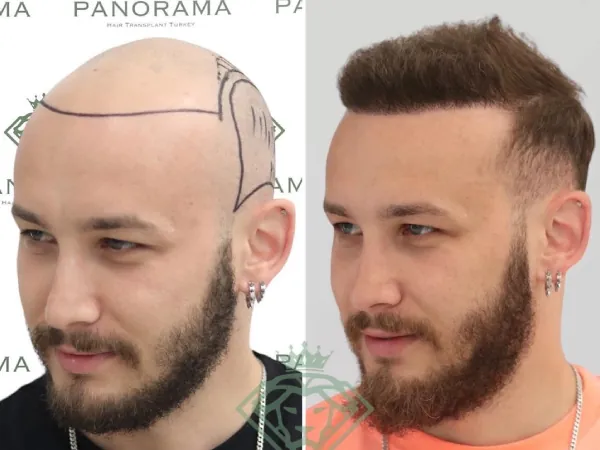 زراعة الشعر قبل وبعد — الحالة 33، تساقط الشعر المتقدم