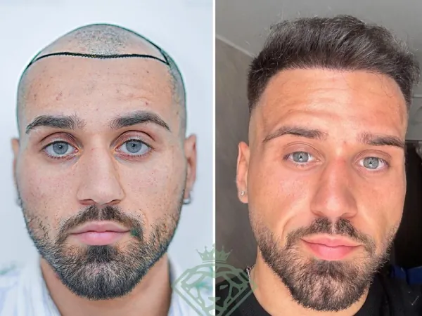 زراعة الشعر قبل وبعد — الحالة 34، انحسار خط الشعر