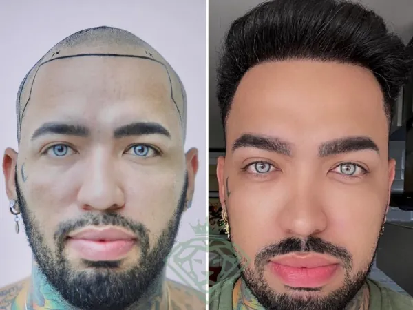 زراعة الشعر قبل وبعد — الحالة 35، انحسار خط الشعر