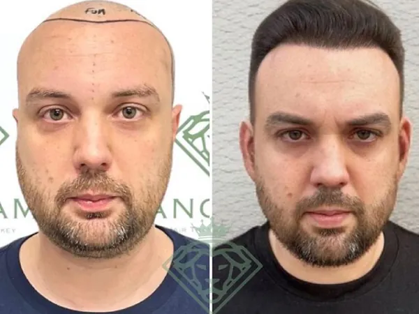 زراعة الشعر قبل وبعد — الحالة 36، تساقط الشعر المتقدم