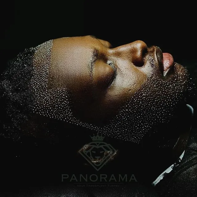 Hair grafts prepared for transplantation