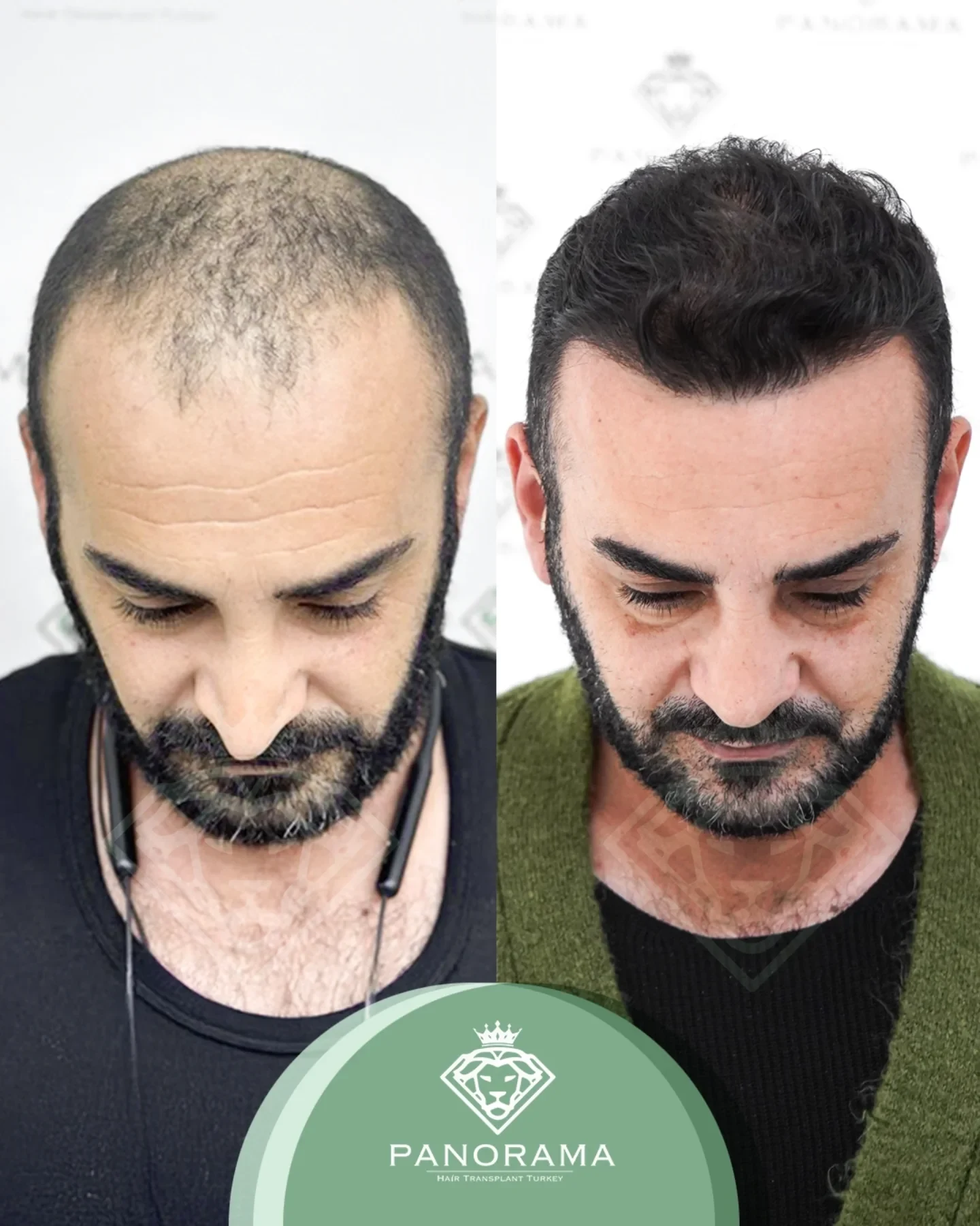 زراعة الشعر قبل وبعد — الحالة IG-13، انحسار خط الشعر