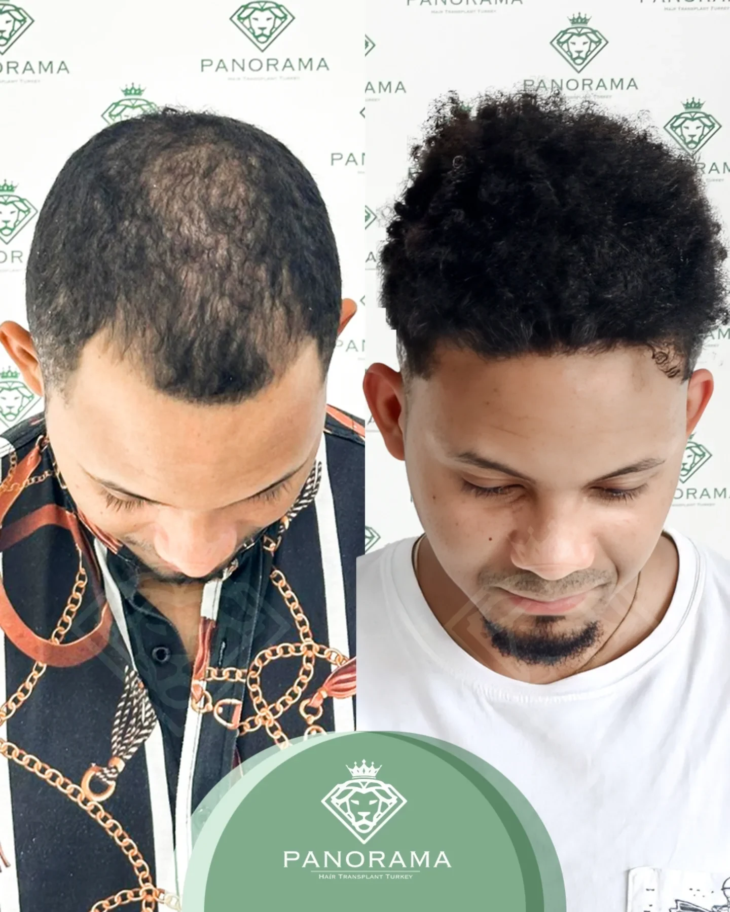 زراعة الشعر قبل وبعد — الحالة IG-12، انحسار خط الشعر