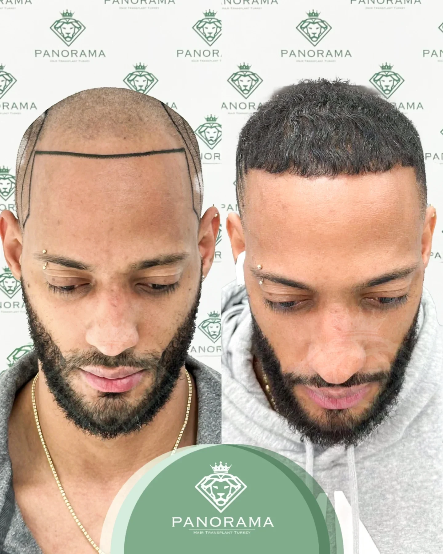 زراعة الشعر قبل وبعد — الحالة IG-11، انحسار خط الشعر