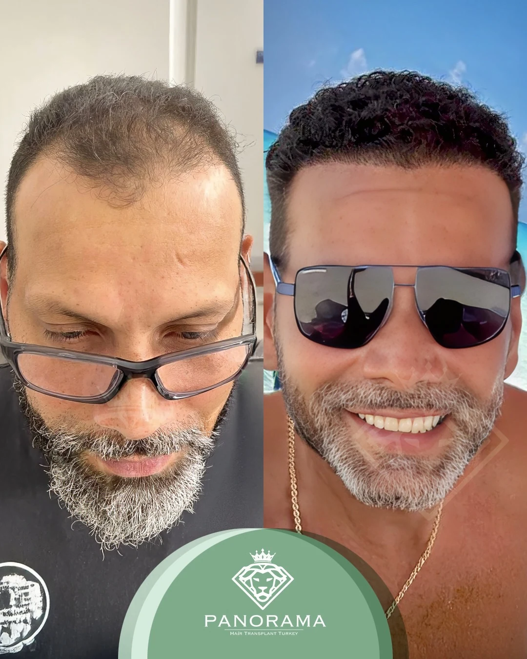 زراعة الشعر قبل وبعد — الحالة IG-14، انحسار خط الشعر