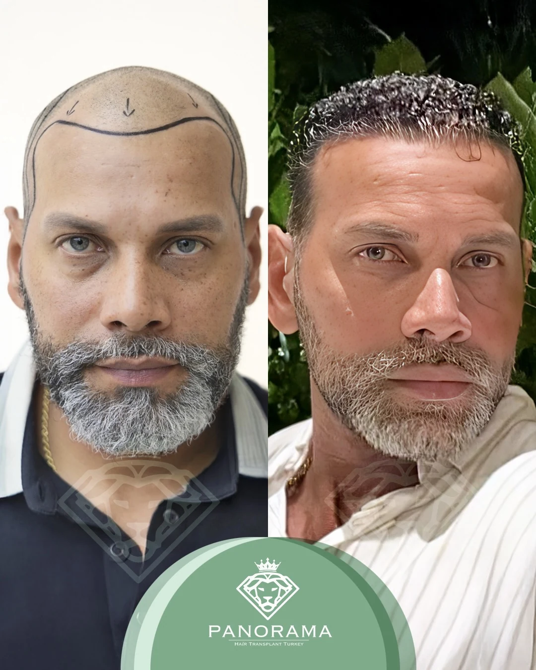 زراعة الشعر قبل وبعد — الحالة IG-15، انحسار خط الشعر