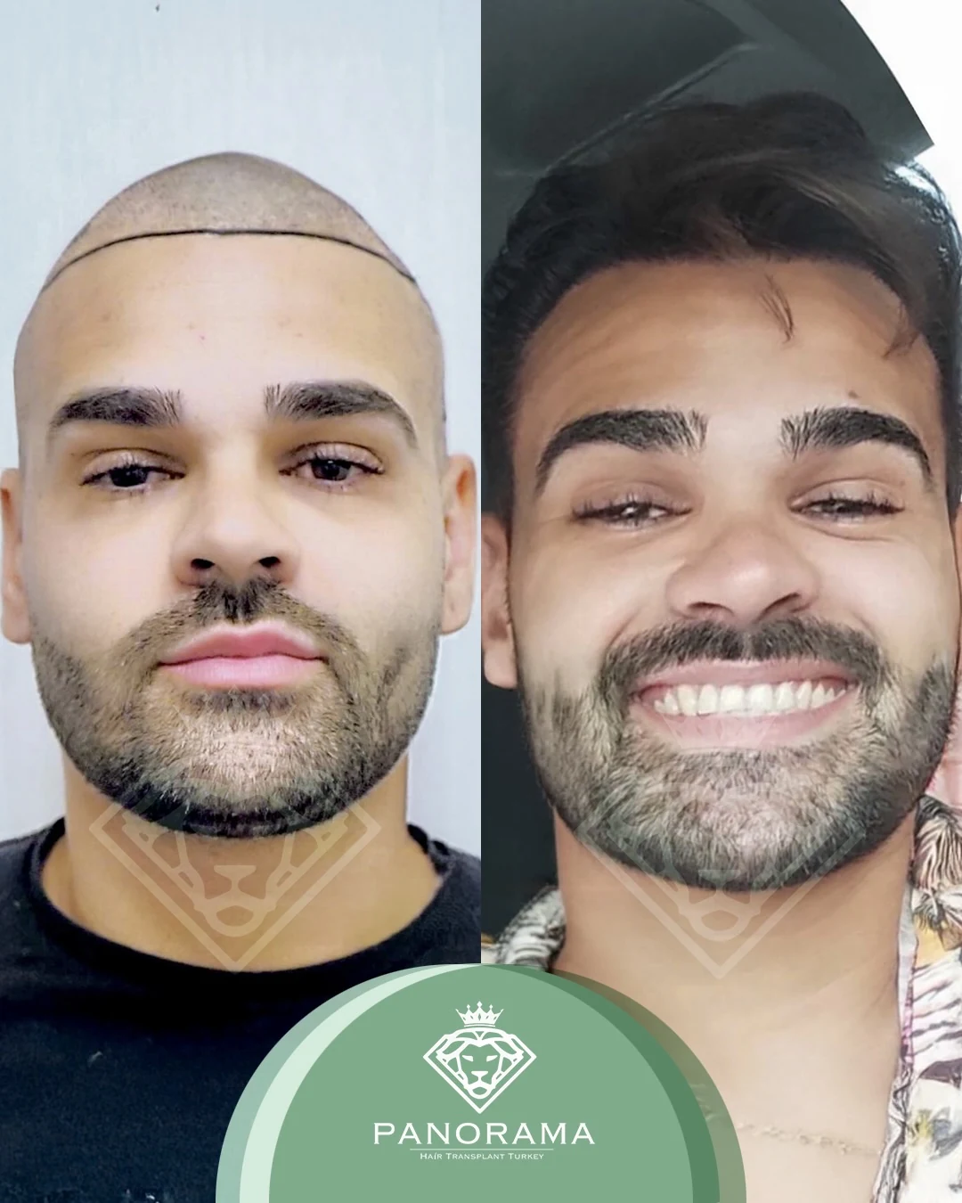 زراعة الشعر قبل وبعد — الحالة IG-16، انحسار خط الشعر
